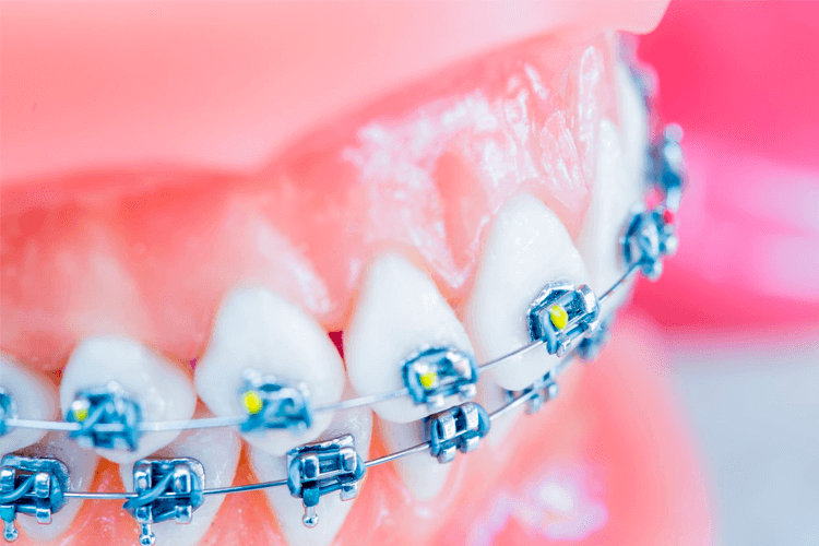 O que é e como funciona um alinhador transparente – Nunes Odontologia –  Belo Horizonte