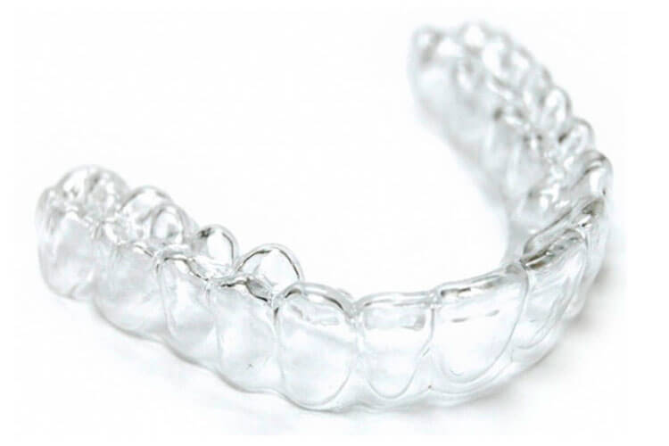Como funciona o alinhador dental transparente? Ele é melhor que o